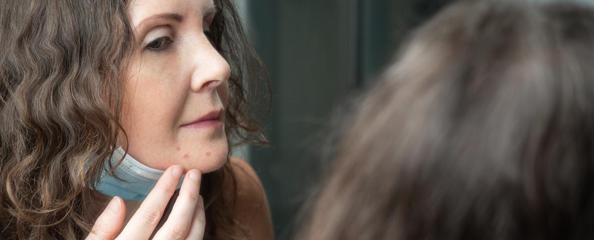 adult acne