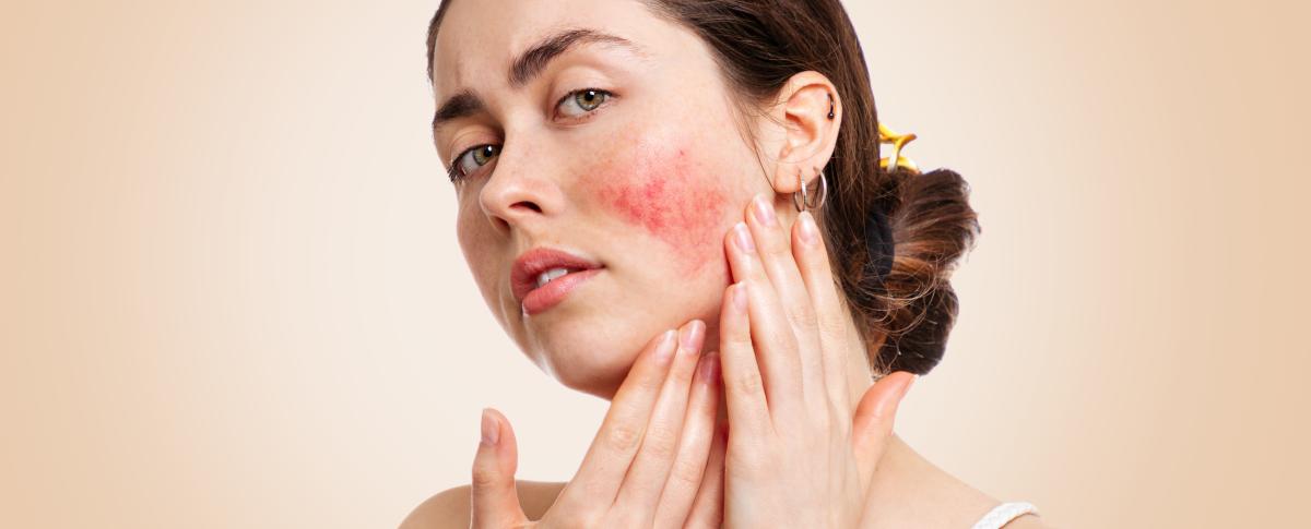 Acne rosacea